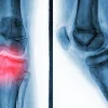 Иллюстрация рентгеновского снимка колена, показывающего боль от артрита
